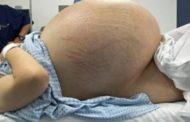 This woman thought she had a baby inside her tummy, But When Doctors operated her They Shocked..
