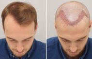 Why It Is Necessary To Use This Hair Transplant Treatment?