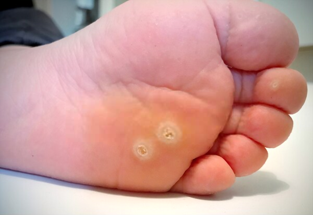 Foot wart removal in Texas: Effective ways to rid of those plantar warts