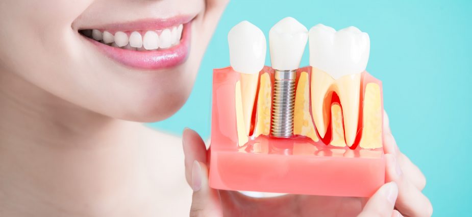 Low-Cost Dental Implants